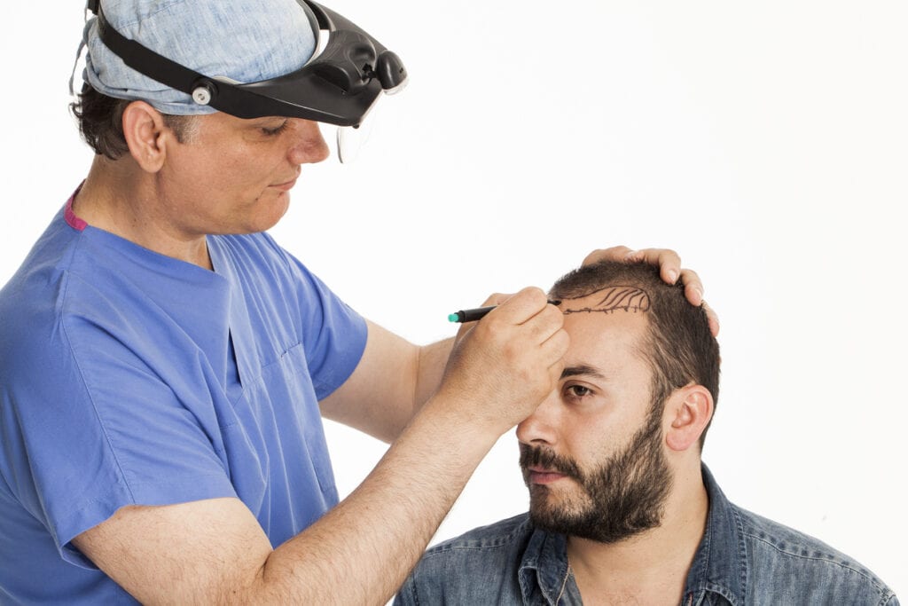 säker hårtransplantation vid håravfall